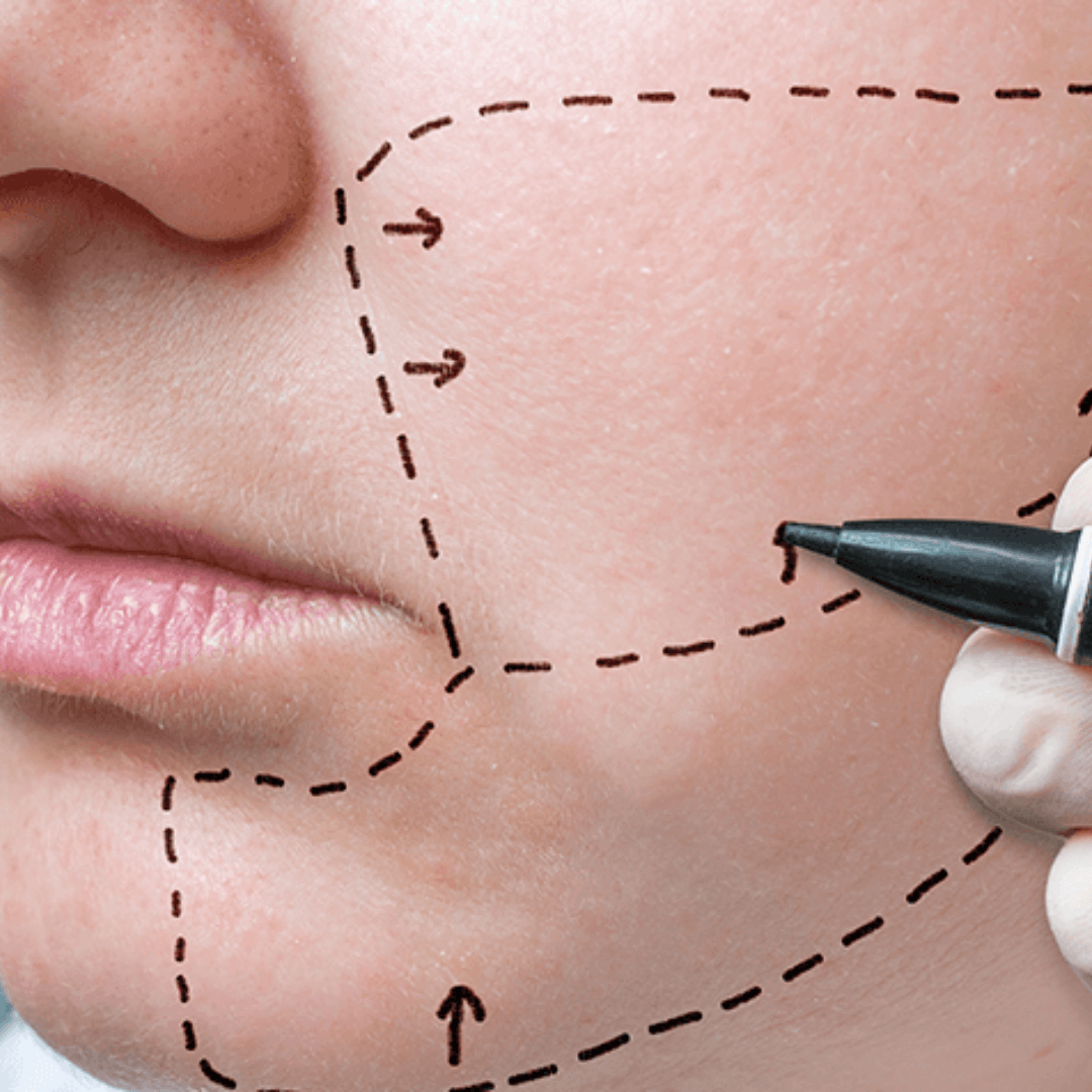 cheek implant